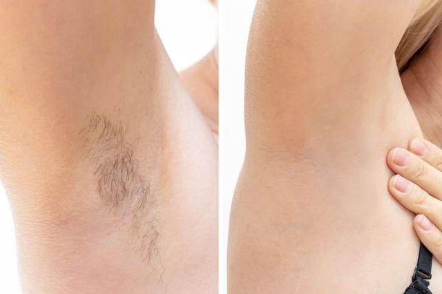 Laser Hair Removal Dualmax Laser Riverside CT Greenwich CT